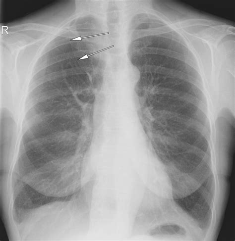 azygos fissure     pa chest radiograph normal variant radiology normal radiographer