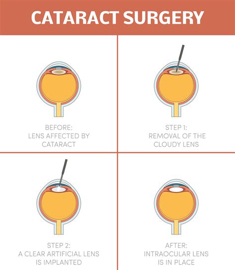 cataract surgery top  myths        series