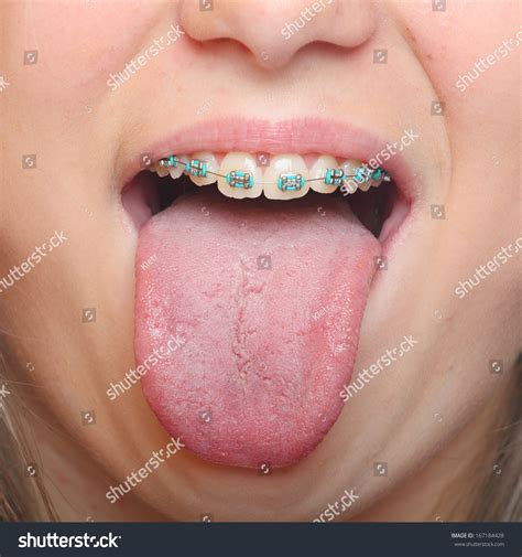 Girl Braces Tongue Images Photos Et Images Vectorielles De Stock