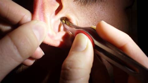 removing impacted ear wax youtube