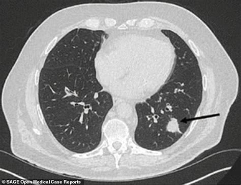 Lung Cancer Patient S Tumors Shrunk In Half After Using