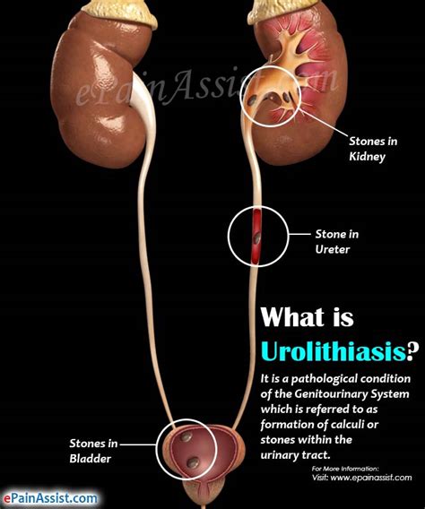 what is urolithiasis causes symptoms treatment diagnosis