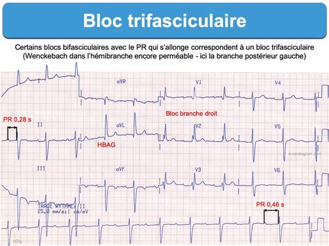 bloc trifasciculaire  cardiogram