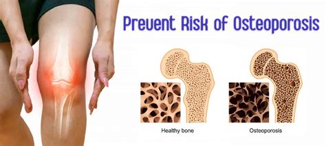 best ways to prevent the risk of osteoporosis medplusmart