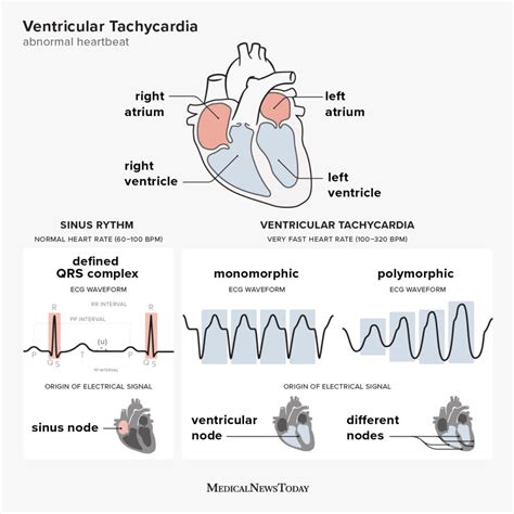 ventricular tachycardia   ventricular tachycardia types