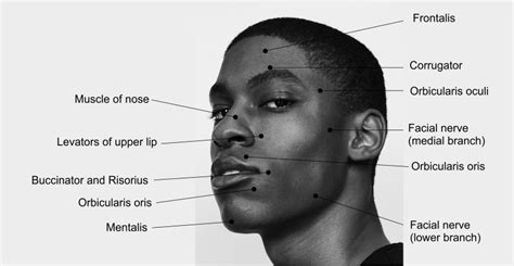 bells palsy motor points