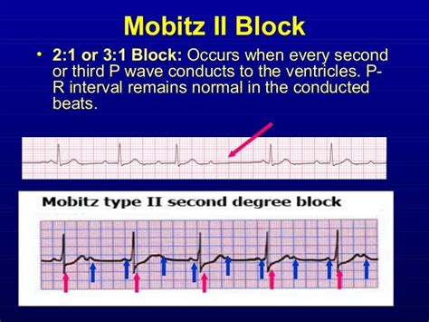 2nd Part Ecg Basics Pr Interval And Heart Block