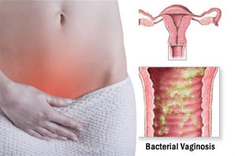 comportamiento de la vaginosis bacteriana por gardnerella vaginalis centro municipal de higiene