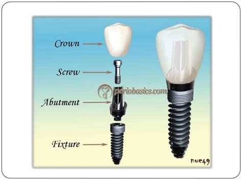 implant components  function