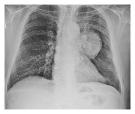 Chest X Ray Of A Patient Showing A Mass Lesion Located Left Hiler