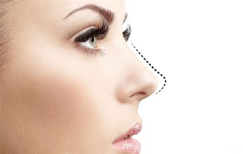 botox cuping hidung makin mancung  ideal beauty  clinic