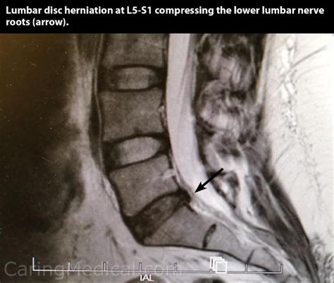 alternatives to spinal fusion surgery and revision spinal fusion