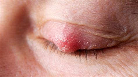 what is a chalazion symptoms causes diagnosis treatment and