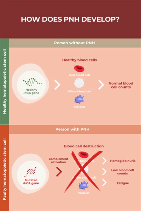 paroxysmal nocturnal hemoglobinuria pnh pnh news