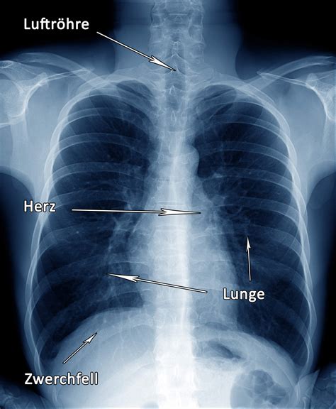 roentgen thorax lunge gruende ablauf bilder praktischarzt