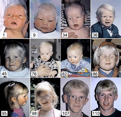 Albinism Oculocutaneous Type Ib Disorder Semantic Scholar