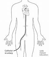 Angiogram Heart Femoral Artery Disease Diagnosing Through Groin Catheter Diagram Cardiac Area Going Inserted Diagnose Common sketch template