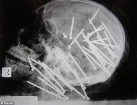 Extraordinary X Ray Reveals How Murderer Executed Victim