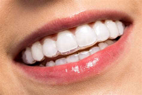 straighten teeth  invisalign clear braces regent dental cambridge