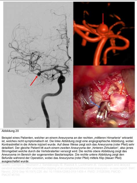 aneurysma dissektion av fistel eds gehirn wirbelsaeule