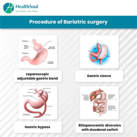 Bariatric Surgery Indications And Risks Healthsoul
