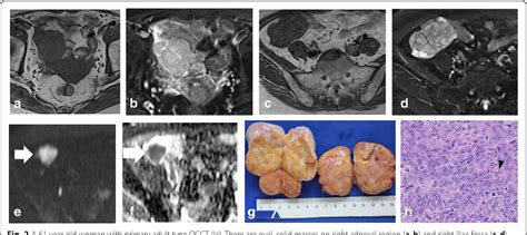 Figure 2 From Mr Findings Of Primary Ovarian Granulosa Cell Tumor With