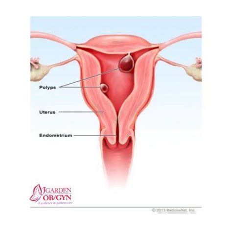 How To Recognize And Treat Uterine Polyps Garden Ob Gyn Obstetrics
