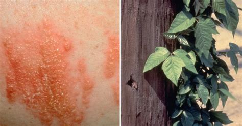 Poison Ivy Sun Poisoning Heat Rash A Guide To Summer Rashes