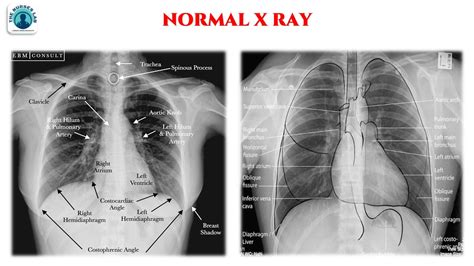 abnormal chest  ray interpretation
