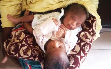 woman gives birth to conjoined twins in bauchi photo nigeria news
