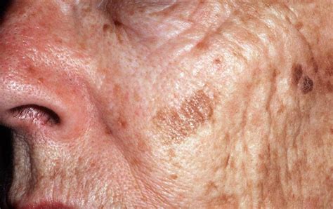 dark age spots  face