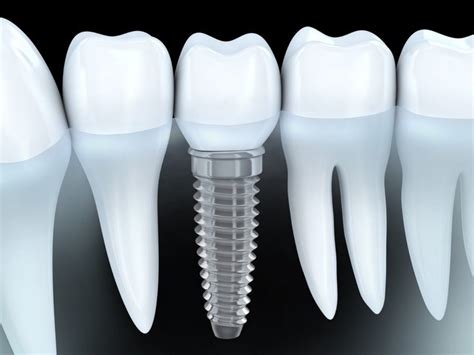 complete guide    dental implant redd community