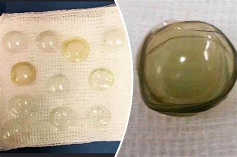 woman has 27 contact lenses removed from eye and she hadn t even noticed they were there