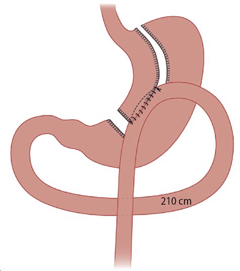 Illustration Of The One Anastomosis Gastric Bypass