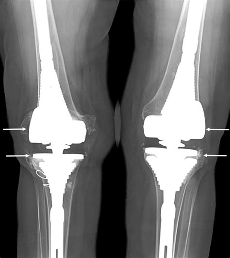 cureus readmission  revision total knee arthroplasty
