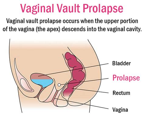 Pelvic Organ Prolapse Female Pelvic Health Center