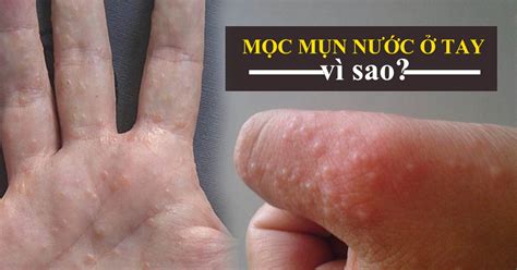 Nổi Mụn Nước ở Tay Có Cách Trị An Toàn Không