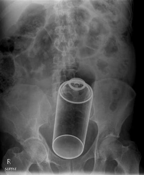 X Ray Images Reveal The Weird Things People Put In Their Butts