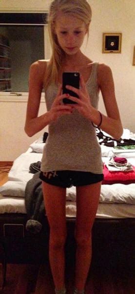 Anorexic Girl Who Was Given Only Days To Live Fights Her Way Out Of A