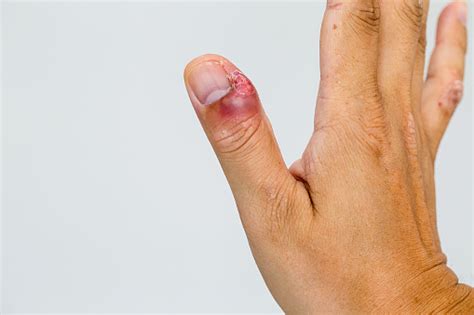 Paronychia Swollen Finger With Fingernail Bed Inflammation Due To