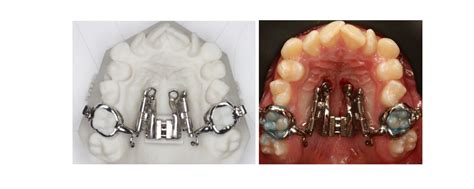rapid maxillary expansion rme      orthodontics  summary