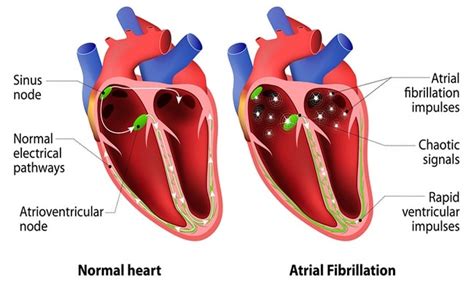 Atrial Fibrillation Disease With Causes And Nursing Intervention