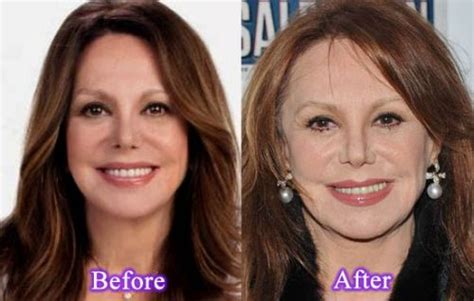 marlo thomas plastic surgery   unnaturally youngerlooks