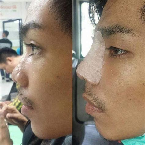 nose bridge augmentation  man  rhinoplasty cost pics reviews