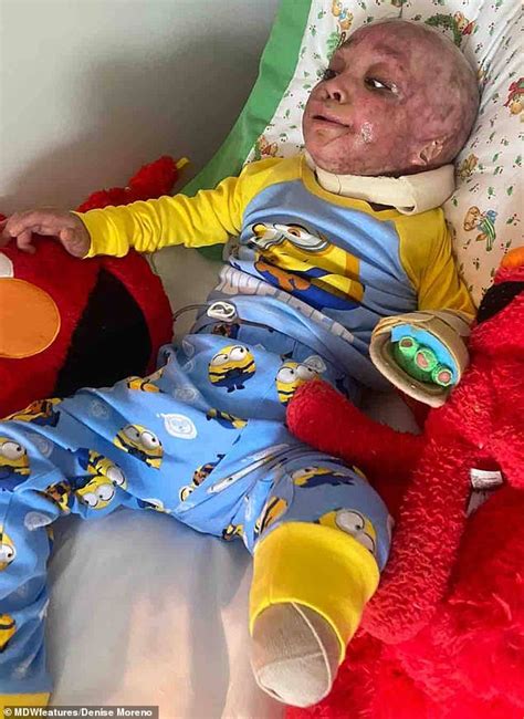 Two Year Old Survives House Fire With Horrific Burns Across 95 Of His