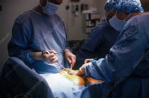 abdominal surgery stock image  science photo library