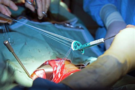 Heart Valve Repair Surgery Photograph By Antonia Reeve