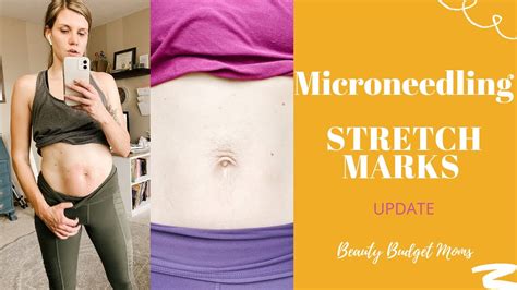 microneedling stretch marks youtube