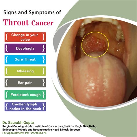 dr saurabh gupta oncologist signs symptoms  throat cancer
