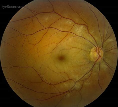Online Atlas Of Ophthalmology The University Of Iowa